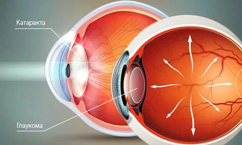 Удаление катаракты и глаукомы