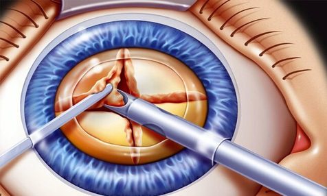 Факоэмульсификация катаракты