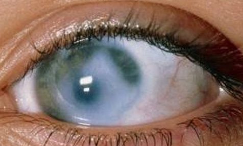 Закрытоугольная глаукома: стадии, симптомы, лечение