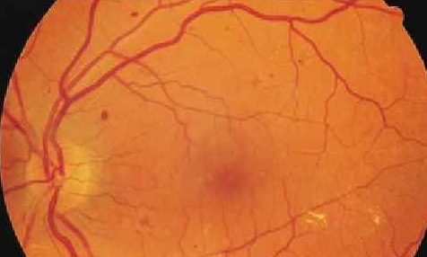 Непролиферативная диабетическая ретинопатия. Стадии. Симптомы. Лечение