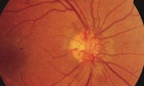 Пролиферативная диабетическая ретинопатия. Стадии. Симптомы. Лечение