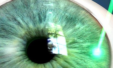 Лазерная операция при глаукоме