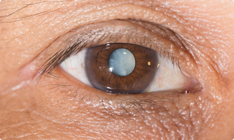 Замена хрусталика глаза при катаракте