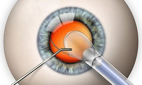Замена хрусталика глаза при близорукости
