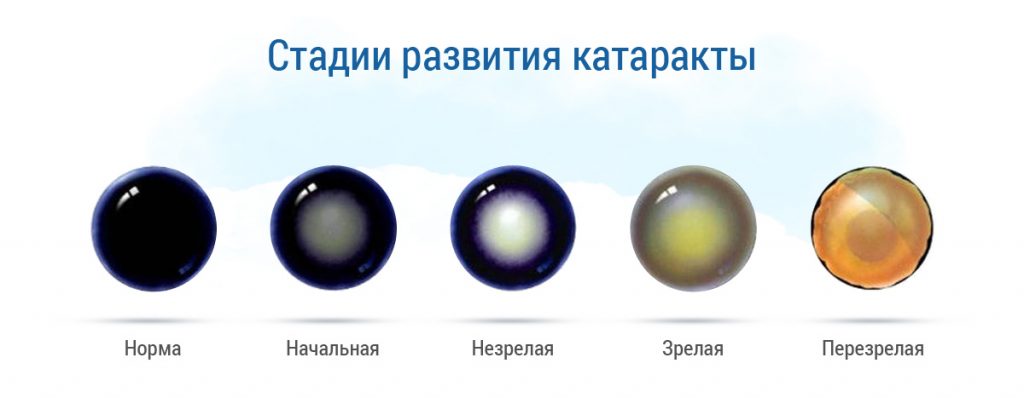 Стадии развития катаракты