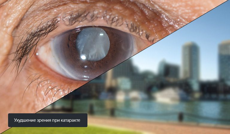Ухудшение зрения при катаракте