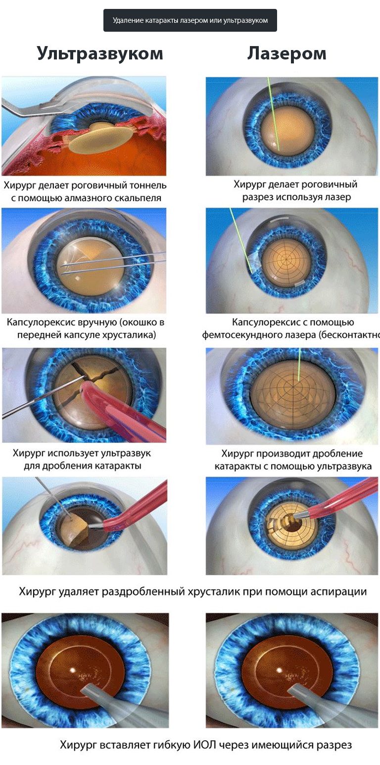 Удаление катаракты лазером или ультразвуком