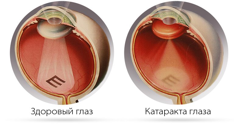 Здоровый глаз и катаракта