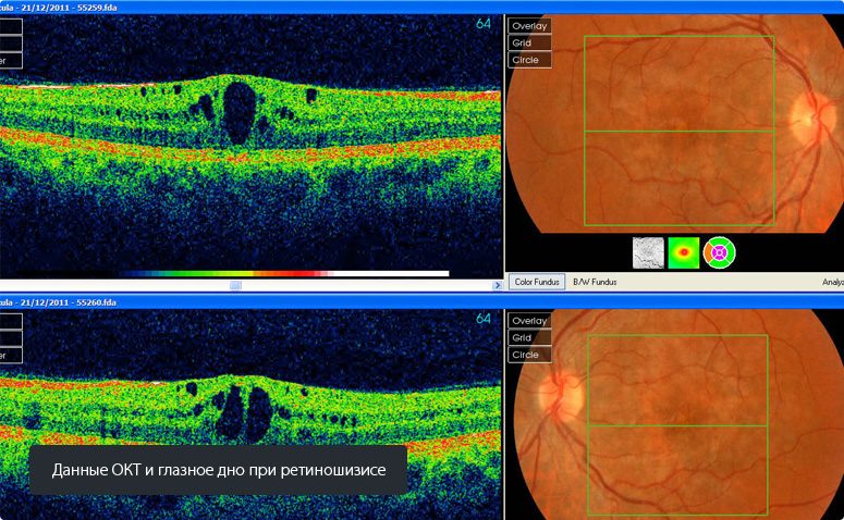 Данные ОКТ и глазное дно при ретиношизисе